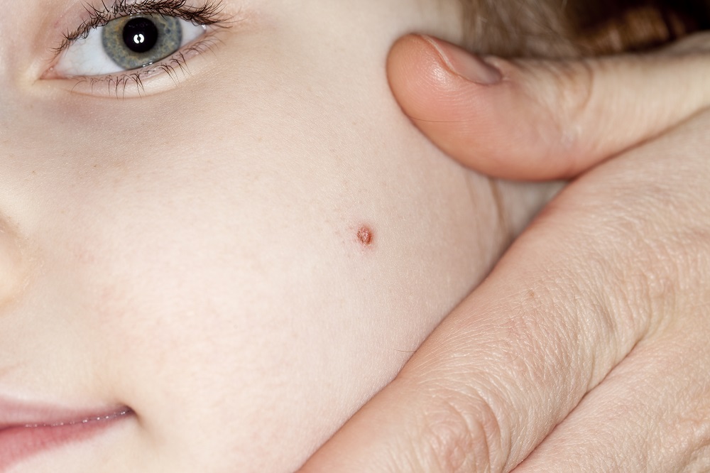 Uncovering the Path to Clear Skin: Warts Skin Plastic Surgery Treatment